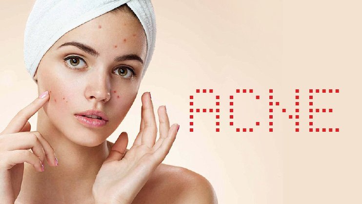 How to overcome the Acne Problem?